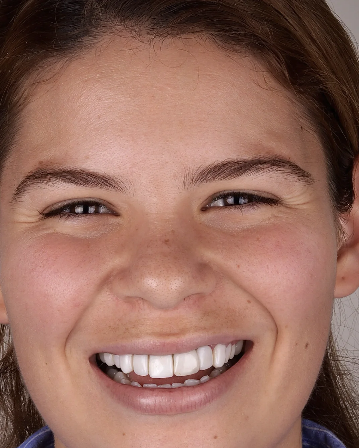 Antes: facetas em resina, caso 1