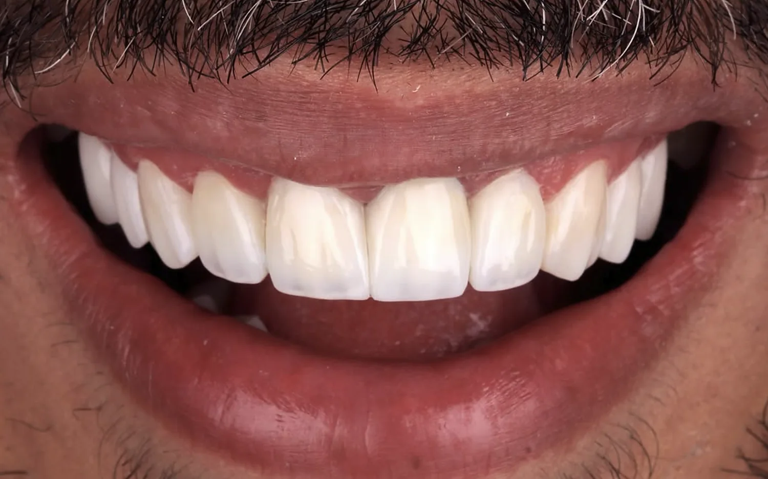 Depois: facetas em resina, caso 2