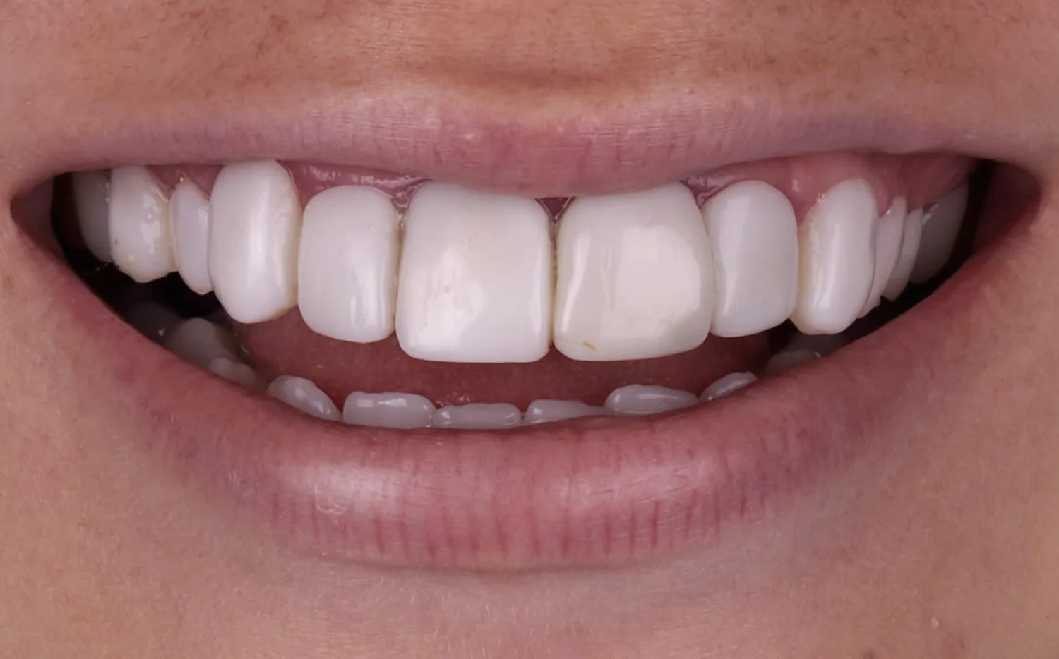 Antes: retrabalho de facetas em resina