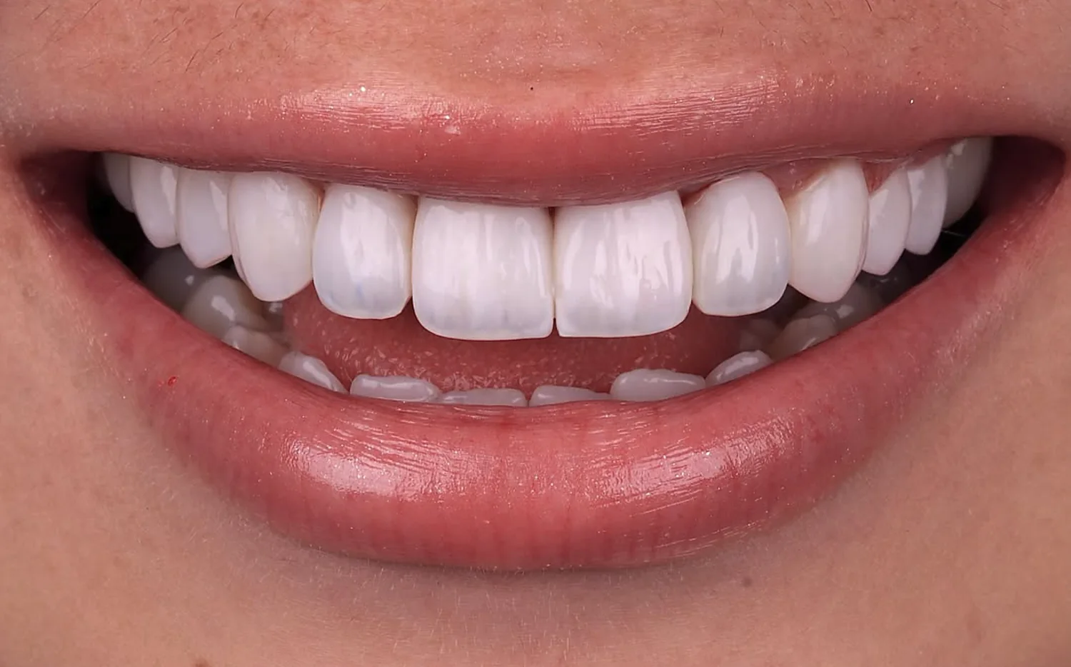 Depois: retrabalho de facetas em resina